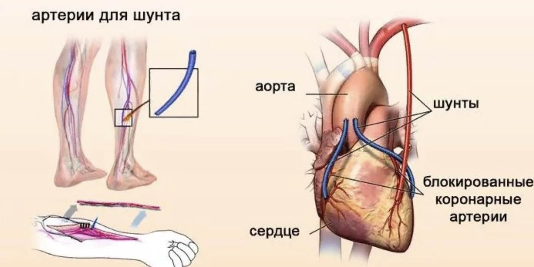 Что такое шунтирование сердца и сосудов. Аортокоронарное шунтирование схема операции. Шунтирование сосудов при инфаркте миокарда. Коронарное шунтирование сосудов сердца. Операция шунтирование сердца инфаркт.